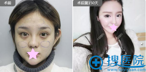 <!--<i data=20240710 data-id=12374></i>-->整形美容医院自体脂肪填充苹果肌案例 <!--<i data=20240710 data-id=12374></i>-->整形美容医院自体脂肪填充苹果肌案例