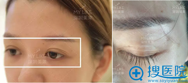 深圳美莱梁志为怎么样?全切双眼皮真人案例恢复过程图为你揭晓