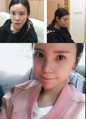 重庆联合丽格朱红振做鼻子怎么样?看过鼻综合案例就知道