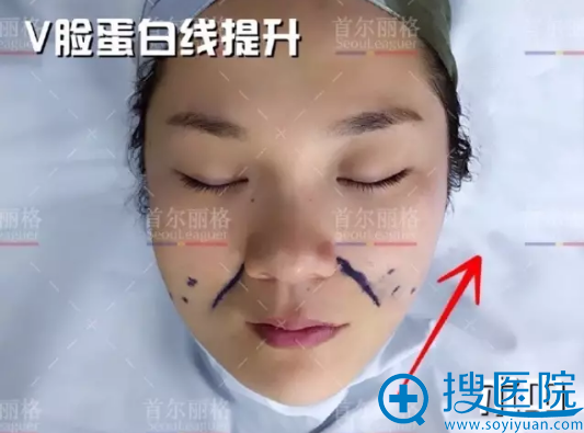 面部线雕手术中 面部线雕手术中