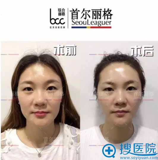 面部线雕前后对比照 面部线雕前后对比照