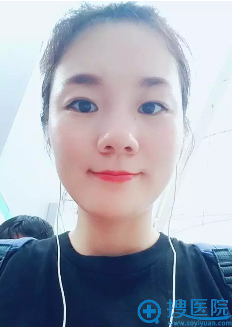 面部线雕提升术后第五天 面部线雕提升术后第五天