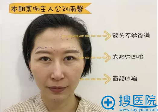 上海首尔丽格金柱自体脂肪填充案例 过来人告诉你填充真实感受