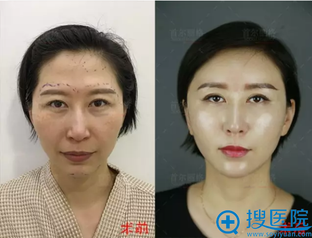 面部脂肪填充前后对比照 面部脂肪填充前后对比照
