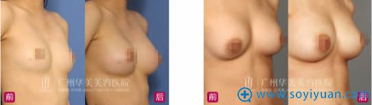 广州华美整形医院丰胸前后对比案例 广州华美整形医院丰胸前后对比案例