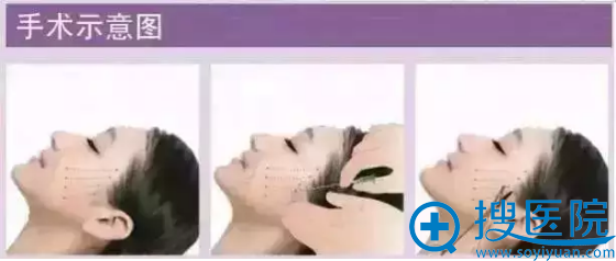 扬州iface线雕逆龄术1年后恢复对比图 用一根线拉回你的青春