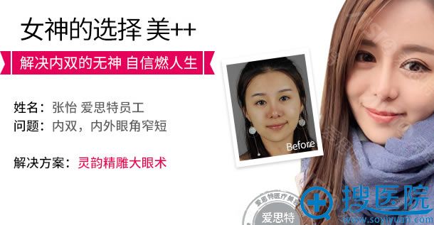 <!--<i data=20240710 data-id=14448></i>-->内双变双眼皮案例 <!--<i data=20240710 data-id=14448></i>-->内双变双眼皮案例