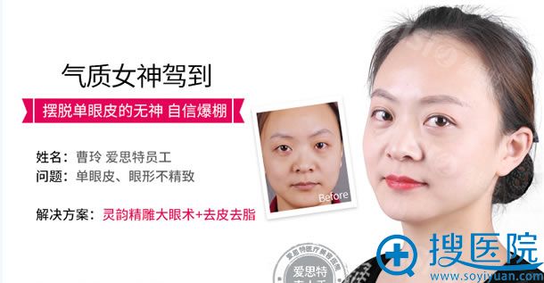 <!--<i data=20240710 data-id=14448></i>-->单眼皮变双眼皮效果 <!--<i data=20240710 data-id=14448></i>-->单眼皮变双眼皮效果