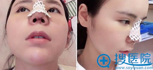 朱红振院长鼻综合术后第4天照片 朱红振院长鼻综合术后第4天照片