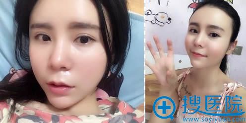 朱红振鼻综合案例效果图 朱红振鼻综合案例效果图