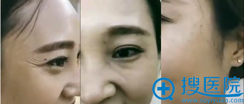 新疆伊丽莎白去鱼尾纹3天后对比效果图 新疆伊丽莎白去鱼尾纹3天后对比效果图