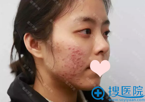 【亲身经历】分享我在重庆华美做激光祛痘印过程图和每天变化图