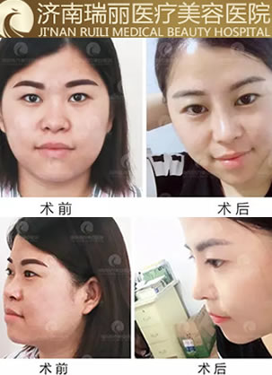 济南瑞丽整形王召东隆鼻怎么样?9800元鼻综合案例为你揭晓