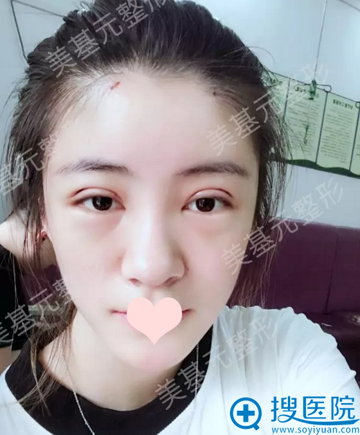 双眼皮术后天效果 双眼皮术后天效果