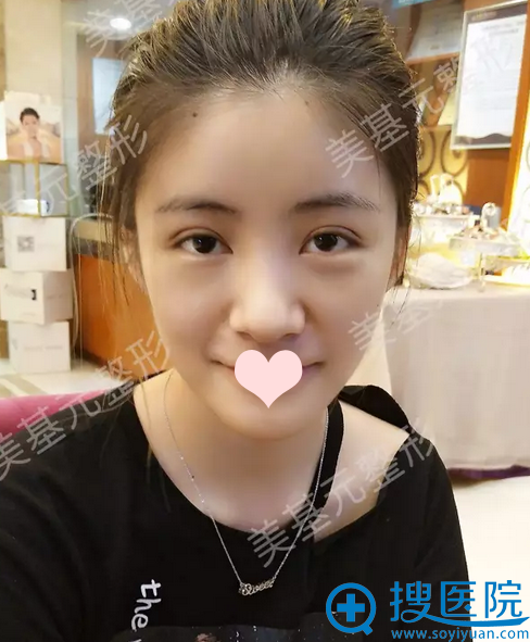 双眼皮术后第二天有点肿 双眼皮术后第二天有点肿