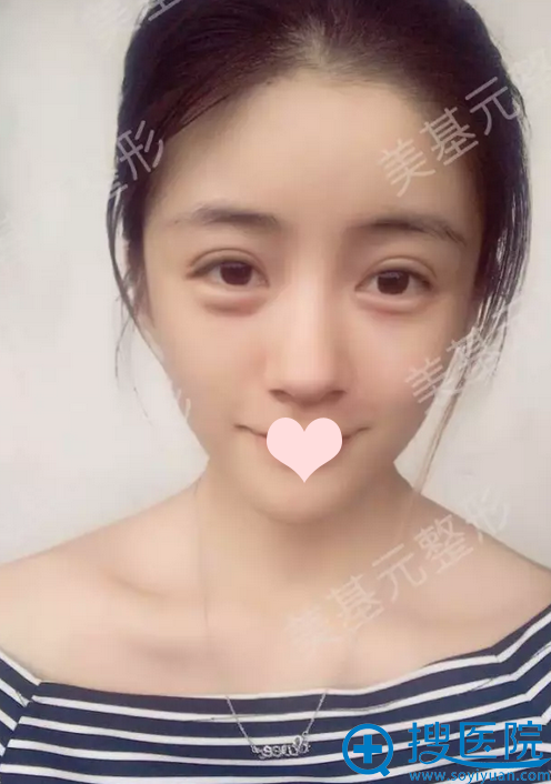 双眼皮术后第7天 双眼皮术后第7天