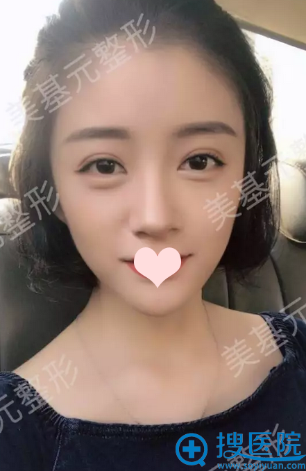 双眼皮12天了,超自然 双眼皮12天了,超自然
