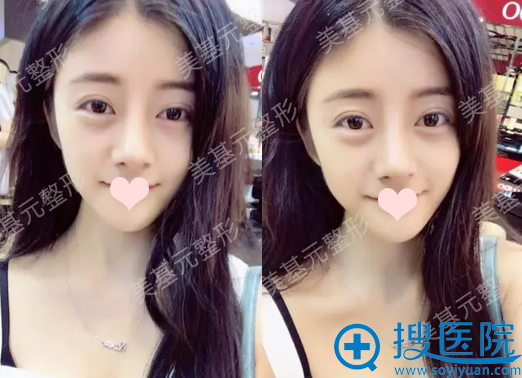 鼻综合术后13天生活照 鼻综合术后13天生活照
