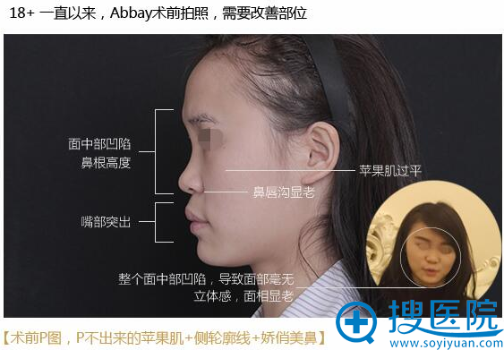 沃尔鼻整形术效PK自拍P图部位 暑期美鼻节8.8折等你来哦!