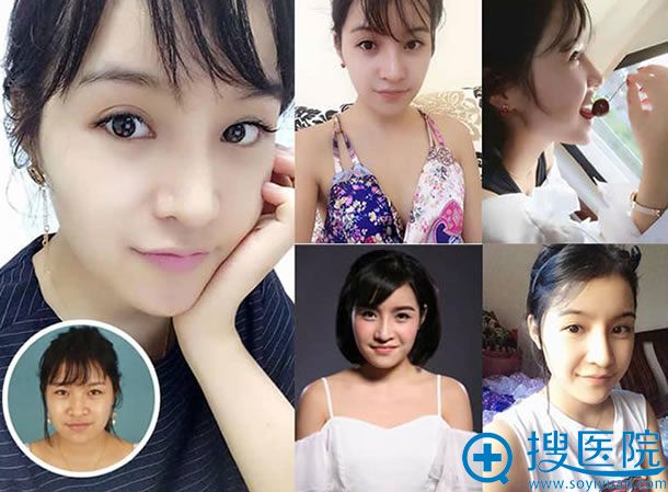 南宁华美胡凯院长鼻修复案例图 南宁华美胡凯院长鼻修复案例图