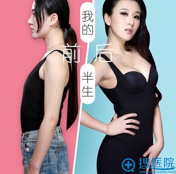 南宁华美蜜桃美胸案例图 南宁华美蜜桃美胸案例图
