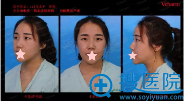 重庆当代邹大龙院长设计双眼皮手术方案 重庆当代邹大龙院长设计双眼皮手术方案