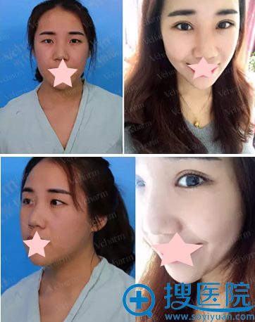 重庆当代邹大龙双眼皮手术前后对比照片 重庆当代邹大龙双眼皮手术前后对比照片