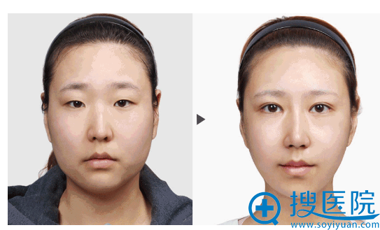 <!--<i data=20240710 data-id=14178></i>-->整形美容医院双眼皮案例 <!--<i data=20240710 data-id=14178></i>-->整形美容医院双眼皮案例