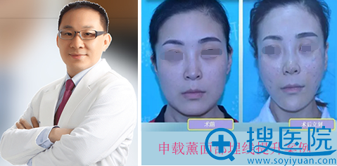 <!--<i data=20240710 data-id=11048></i>-->申载熏面部埋线提升案例 <!--<i data=20240710 data-id=11048></i>-->申载熏面部埋线提升案例