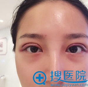 双眼皮第二天 双眼皮第二天