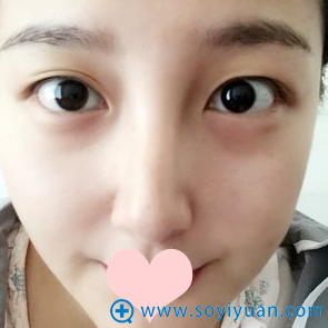 双眼皮术前照片 双眼皮术前照片