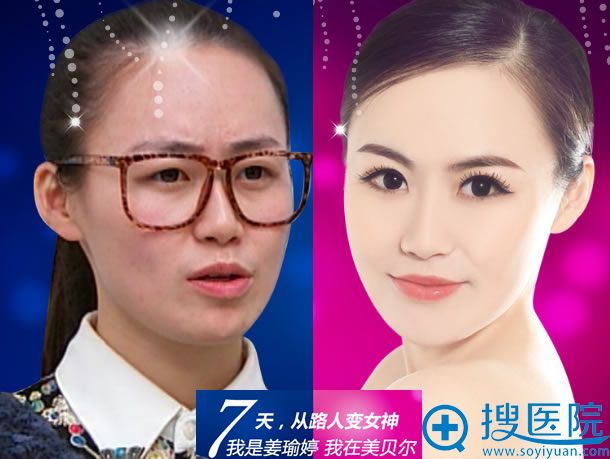 贵阳美贝尔双眼皮整形真实案例 贵阳美贝尔双眼皮整形真实案例