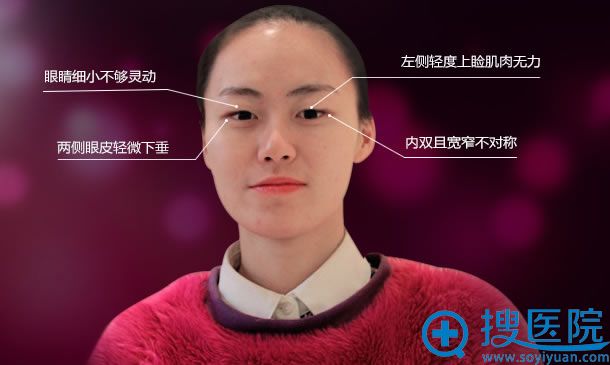 在美贝尔做双眼皮手术前的照片 在美贝尔做双眼皮手术前的照片