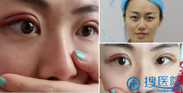 美贝尔双眼皮手术第3天的效果 美贝尔双眼皮手术第3天的效果