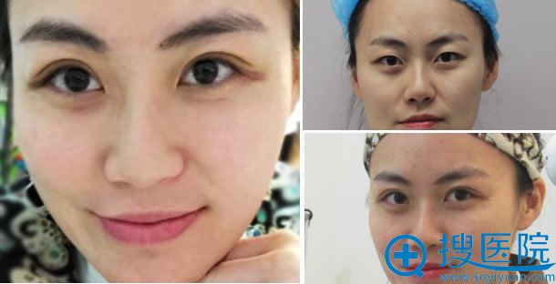 美贝尔双眼皮手术第6天照片 美贝尔双眼皮手术第6天照片