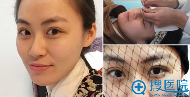 贵阳美贝尔双眼皮手术第7天图片 贵阳美贝尔双眼皮手术第7天图片