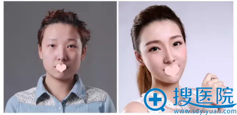 注射前后对比照 注射前后对比照