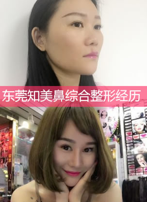 东莞知美整形隆鼻经历分享 15800元找黄双闻院长实现美鼻梦