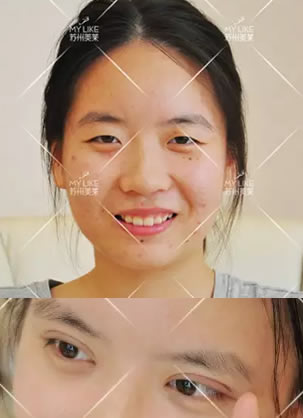苏州美莱尹飞怎么样?双眼皮+开眼角案例恢复效果给你真相
