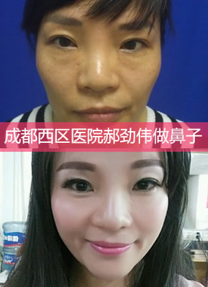 成都西区医院郝劲伟做鼻子怎么样?我的硅胶隆鼻经历告诉你