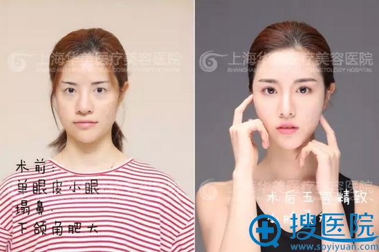 【实例】上海华美双眼皮眼综合+鼻综合+下颌角3个月恢复全过程