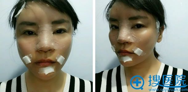 成都西区医院鼻综合即刻效果 成都西区医院鼻综合即刻效果