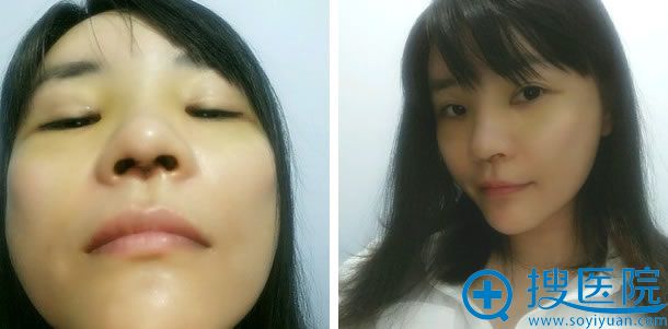 公立医院做鼻综合手术第4天照片 公立医院做鼻综合手术第4天照片