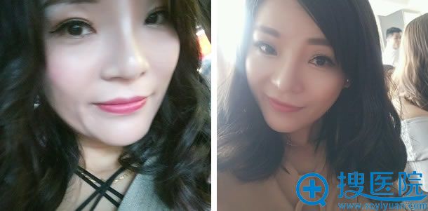 做完鼻综合和全脸脂肪填充第50天 做完鼻综合和全脸脂肪填充第50天
