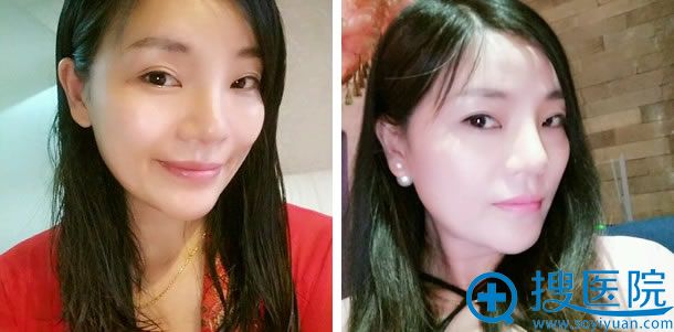 鼻综合整形手术第66天效果图 鼻综合整形手术第66天效果图