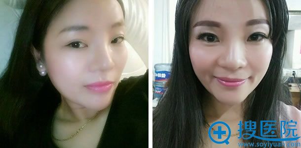 鼻综合和全脸脂肪填充第88天照片 鼻综合和全脸脂肪填充第88天照片