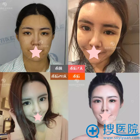石家庄蓝山杜建龙面部自体脂肪填充+鼻综合术后恢复过程 石家庄蓝山杜建龙面部自体脂肪填充+鼻综合术后恢复过程