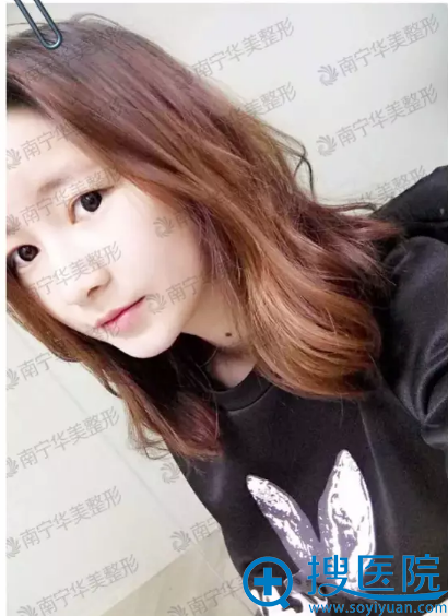 南宁华美整形医院双眼皮案例 18岁少女40分钟内脱“单”全过程