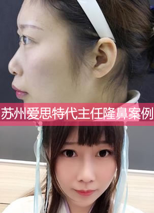 苏州爱思特代主任做鼻子案例效果 88天成功摆脱塌鼻子肉鼻头