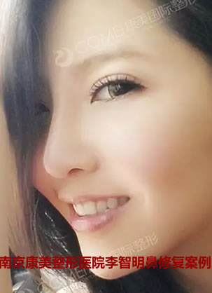 南京鼻修复哪家医院好?看过康美李智明鼻部修复案例就知道